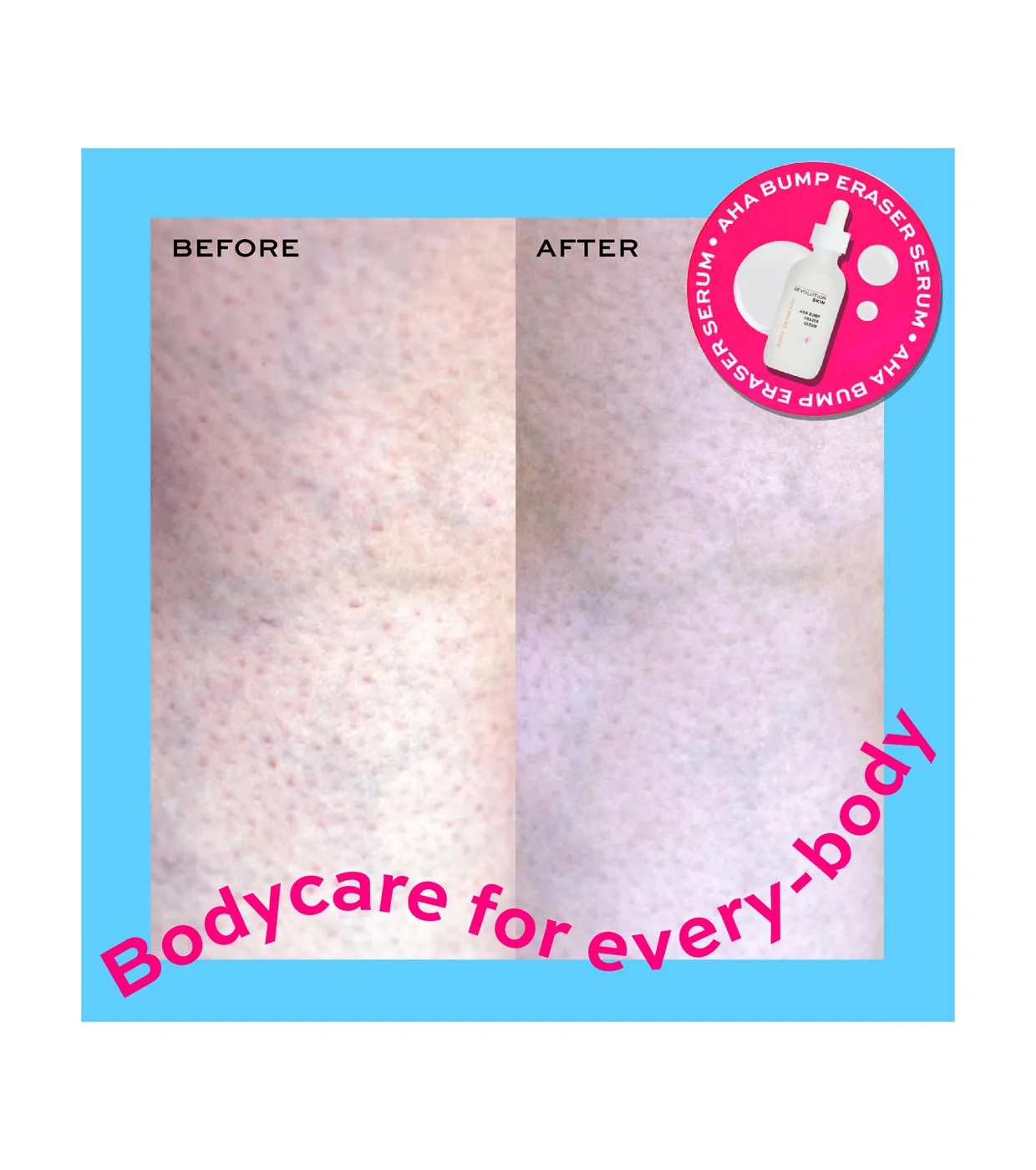 REVOLUTION SKINCARE  *BODY SKINCARE*  SéRUM CORPORAL AHA BUMP ERASER